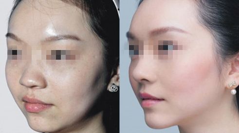 怎樣取出隆鼻假體？隆鼻假體取出有什么風(fēng)險和注意事項？