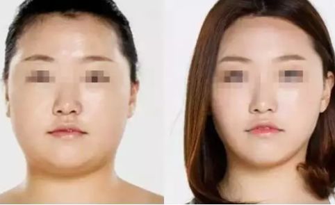 如何瘦腿？吸脂還是塑形？方法對比與價格解析