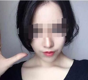 穆雄錚顴骨整形手術解析，修復顴弓美麗重生！顴骨整形術后恢復時間淺析