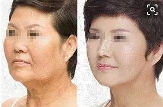 15歲女孩整容成果驚人！爸媽都認不出來了