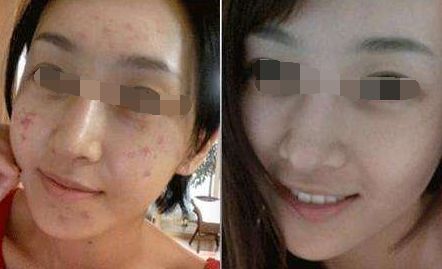 腿部吸脂術(shù)后出現(xiàn)腳腫現(xiàn)象，如何緩解？
