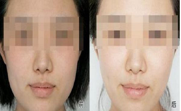 修復雙眼皮失敗的方法與效果，全面解析助你成功擁有完美雙眼皮