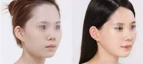 假體隆鼻手術(shù)帶來正自然效果，狀似真實鼻形