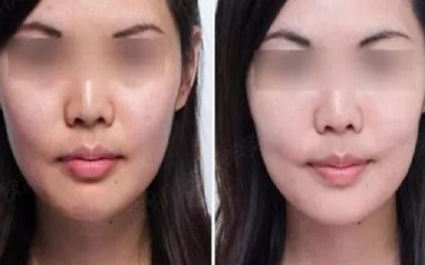 35歲采用超聲療程好還是熱瑪吉更好？匿名評(píng)測(cè)揭秘！