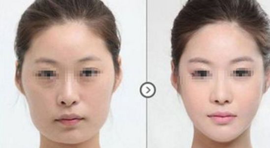 皮膚松弛，如何選擇適合的醫(yī)美項(xiàng)目？熱門方式如熱瑪吉、拉皮等對(duì)比解析！
