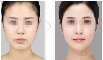 陰道緊縮術(shù)是否痛苦，了解手術(shù)前后的疼痛情況