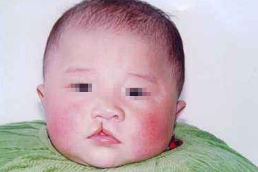處女膜修復(fù)術(shù)后多久能恢復(fù)正常？