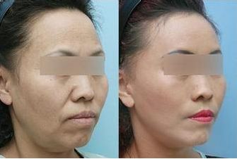 施爾美腹部抽脂：手術(shù)后保持效果長久嗎？