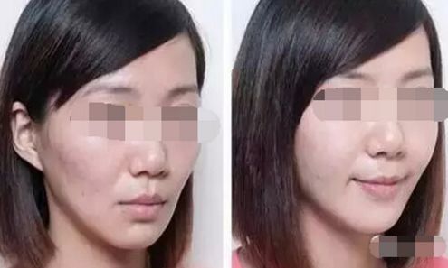 鼻骨矯正術(shù)后護理小貼士