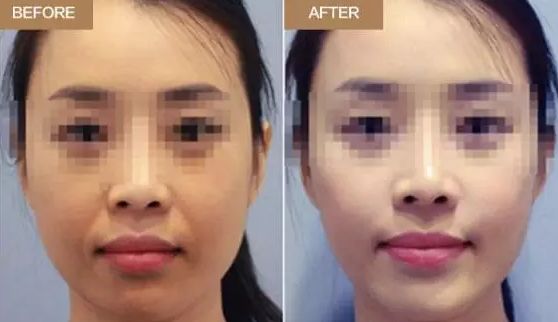 武漢注射法隆鼻價(jià)格、適宜人群都想知道