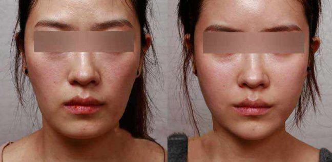眼袋手術(shù)后效果持續(xù)多久？解析專家分享