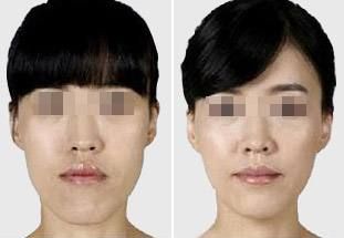 肋骨隆鼻后的面部消腫需要多長(zhǎng)時(shí)間？消腫小竅門曝光！