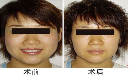 咬肌切除手術(shù)后對面部功能是否會受影響？