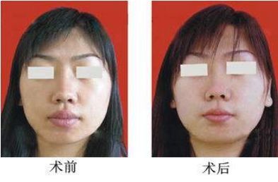 隆鼻手術(shù)費(fèi)用及失敗原因，臨床體征全解析
