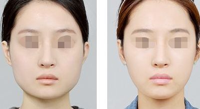 填充鼻唇溝使用玻尿酸安全又有效嗎？
