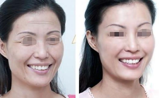 面部吸脂瘦臉效果如何？達(dá)到自然效果的關(guān)鍵是什么