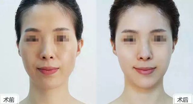 假體隆胸保持持久效果有多久？假體隆胸2個月后是否固定？