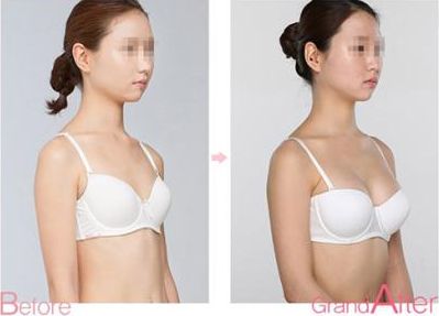 成都耳軟骨復合隆鼻手術：專家解析耳軟骨隆鼻效果及價格、術后護理