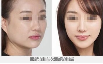 透明質酸注射和美白面膜，保濕與美白兩手抓
