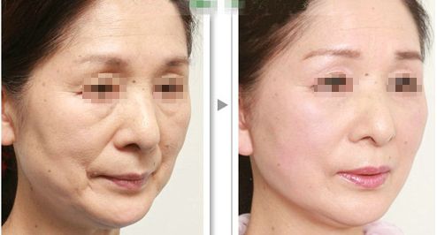 解脂能祛眼袋嗎？多少錢(qián)？功效與注意事項(xiàng)詳解