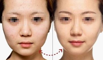 陰道緊縮術(shù)療程多久見效？