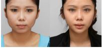 眼袋手術需要麻藥嗎？手術后何時恢復？