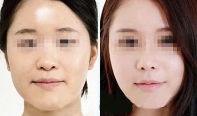激光祛胡脂肪堆積有安全風(fēng)險？您了解情況嗎？