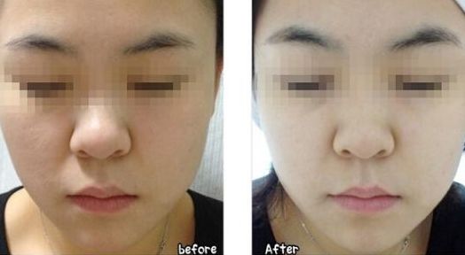 韓式微創(chuàng)無痕處女膜修復(fù)的效果如何？