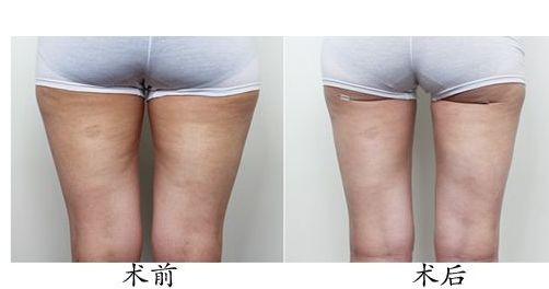 體驗(yàn)光子嫩膚，解密北京光子嫩膚價(jià)格