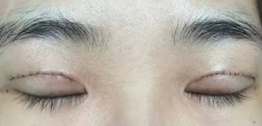 上海王會勇醫(yī)生鼻部整形案例分享：創(chuàng)新技術(shù)助您獲得完美鼻型！
