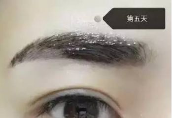 南昌美伊爾劉立軍醫(yī)生膨體隆鼻整形費(fèi)用？手術(shù)效果如何？帶您看醫(yī)生案例