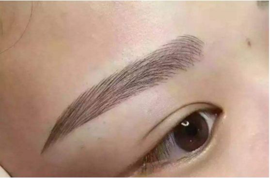 武漢葉子榮做拉皮的療效如何？專家醫(yī)生分享經典案例