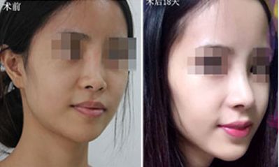 深圳哪家醫(yī)院隆胸效果好？排名前五火熱推薦！