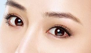 成都米蘭柏羽雙眼皮曝光！醫(yī)生做雙眼皮風格如何？對比照片供參考