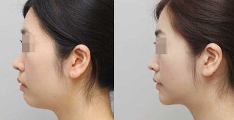 長春哪家醫(yī)院治療肋骨鼻效果好，推薦這些知名醫(yī)院