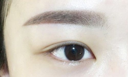 北京郭建玲雙眼皮手術(shù)費用是否昂貴？醫(yī)生案例分享全面解析