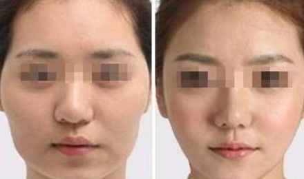 揭秘北京東方和諧脂肪填充真容，真實案例展示精湛技藝！