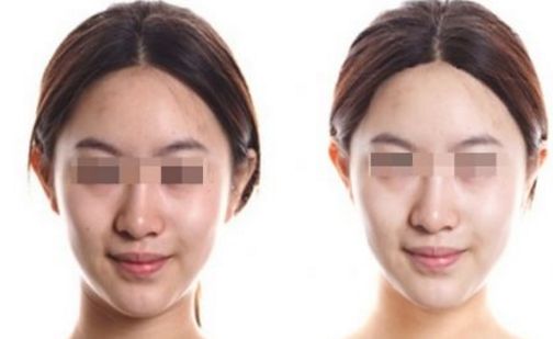 揚(yáng)州煥顏整形：選擇排名靠前的拉皮整形醫(yī)院