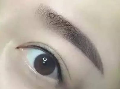 蘇州圣愛(ài)醫(yī)院整形科：90天變化揭示，雙眼皮驚喜盡顯！