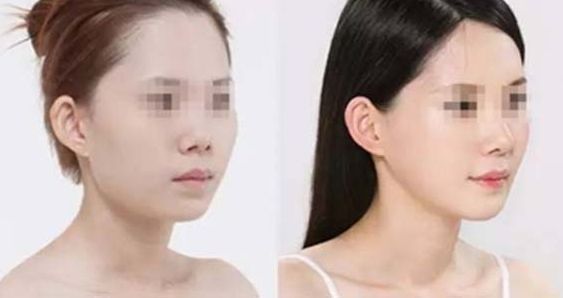 石家莊哪家整形醫(yī)院在隆鼻方面有口碑？