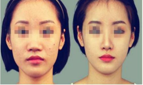 贛州哪家醫(yī)院的鼻部整形好？