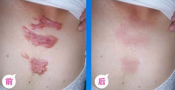 九院脂肪填充，醫(yī)生技術(shù)高超，詳細(xì)價(jià)格表揭曉
