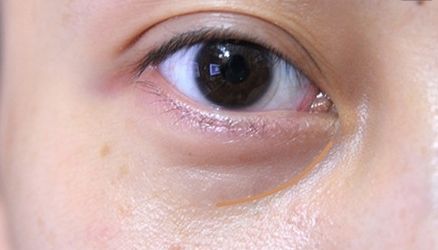 【重慶】銅雀臺雙眼皮醫(yī)生技術(shù)對比，伍森林、王杰醫(yī)、梁海彬誰更厲害？