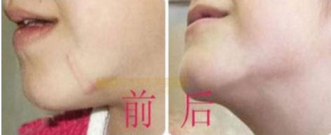 注射玻尿酸前需注意什么？用水清洗可否