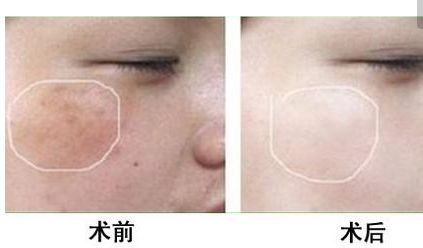 長沙美田芳斌雙眼皮讓你驚艷！令人難忘的改變來襲！