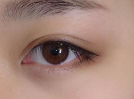 杭州任東做鼻部整容效果如何？MD技術(shù)解析真實案例分享！