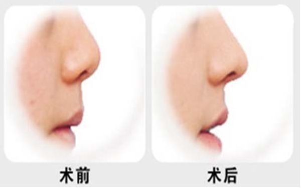 燕雄鼻子整容結(jié)果亮相！專家實(shí)力和成功案例揭秘