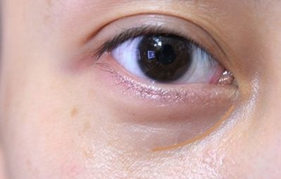 重慶美萊鄭楠醫(yī)生眼部整形術情況、資料及價格請參考