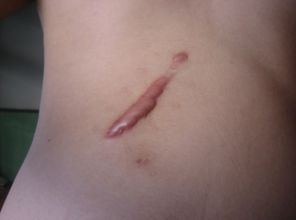 滄州靜港醫(yī)院雙眼皮手術效果如何？哪位醫(yī)生值得信賴？手術費用參考表同步分享