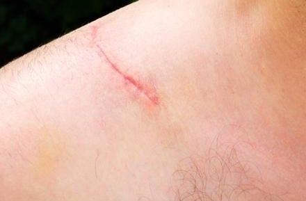 八大處張超面部吸脂效果解析：醫(yī)生技術(shù)實(shí)力、案例與價(jià)格